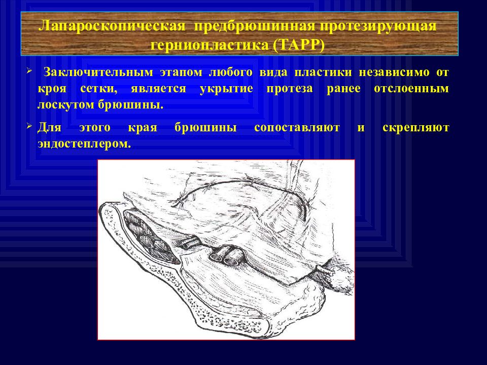 Герниопластика. Лапароскопическая предбрюшинная протезирующая герниопластика. Трансабдоминальная предбрюшинная пластика. Предбрюшинное пространство.