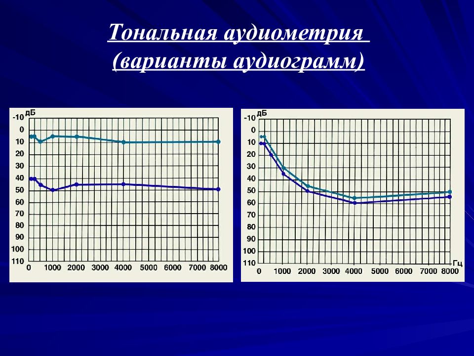 Аудиометрия это. Тональная пороговая аудиометрия норма. Тональная пороговая аудиометрия методика. Аудиометрия- метод измерения. Крутонисходящая аудиограмма.