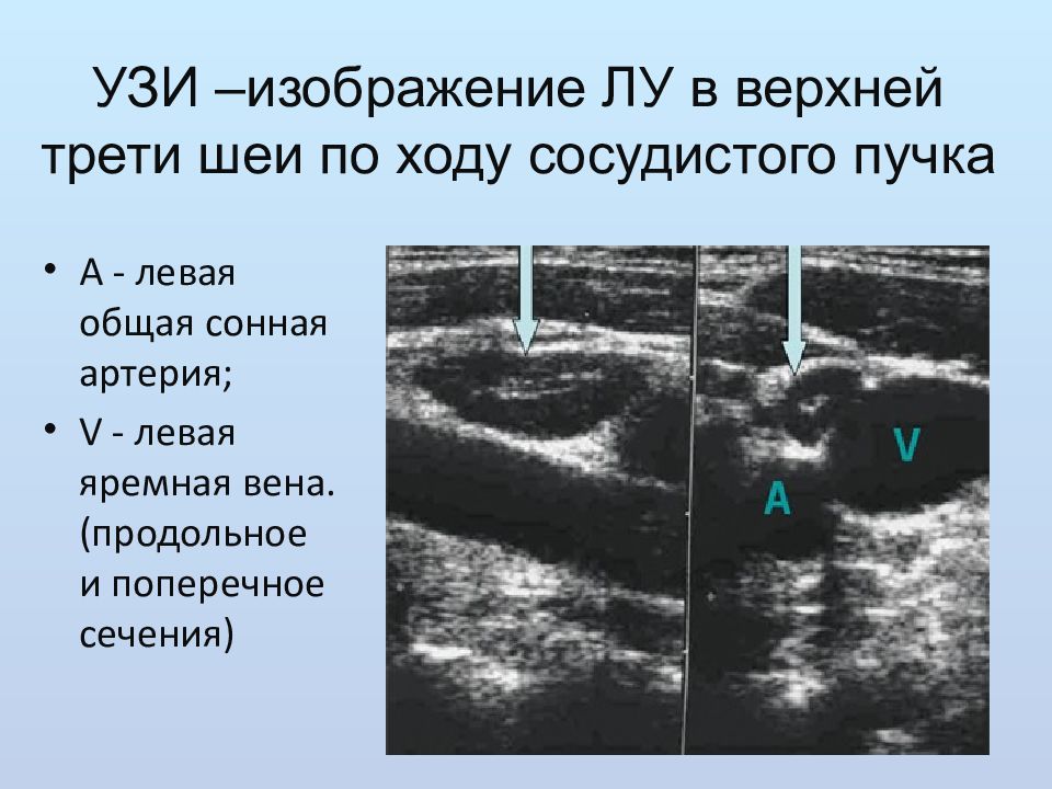 УЗИ внутренней яремной вены.