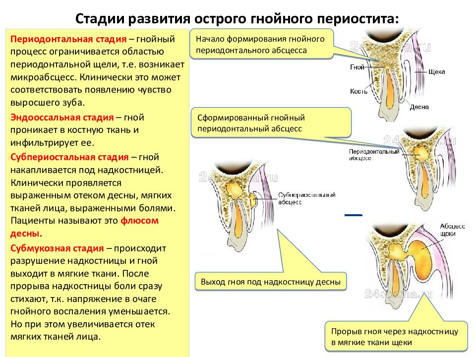 Периостит клиническая картина