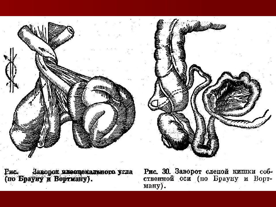 Илеоцекальный заворот. Заворот толстой кишки рентген.