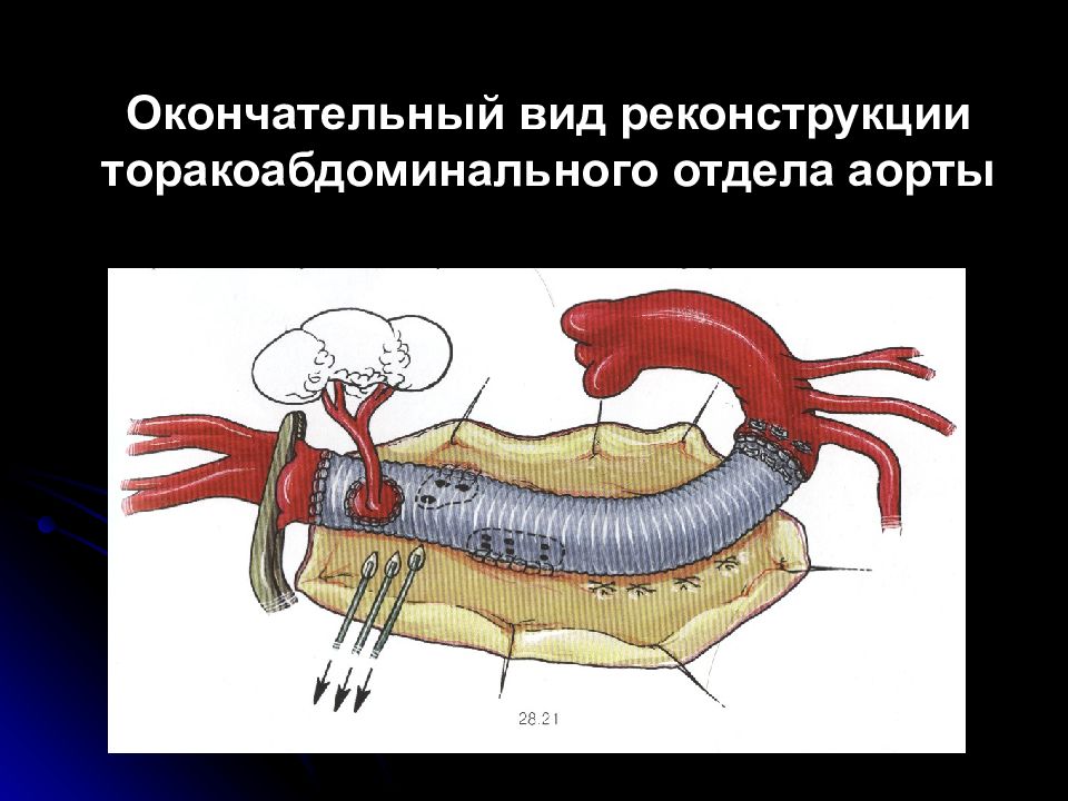 Окончательный вид. Торакоабдоминальной аорте. Заболевания аорты хирургия. Торакоабдоминального отдела аорты. Хирургическая патология аорты.