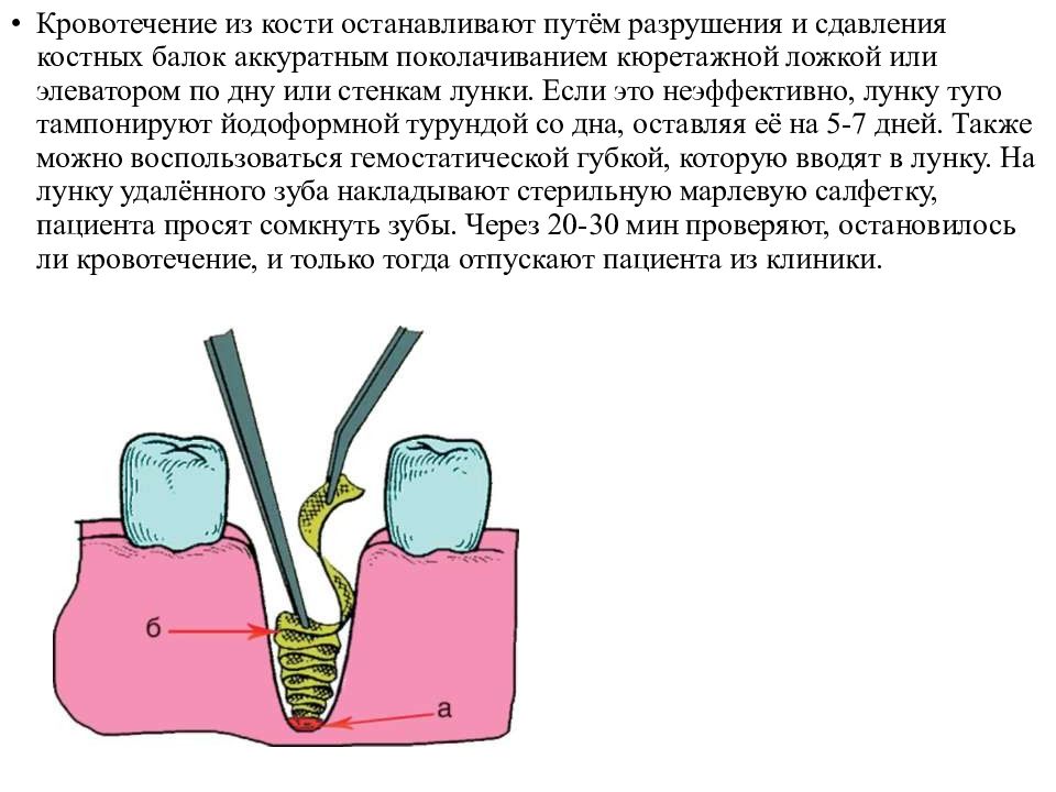 Кровотечение после удаления зуба карта вызова