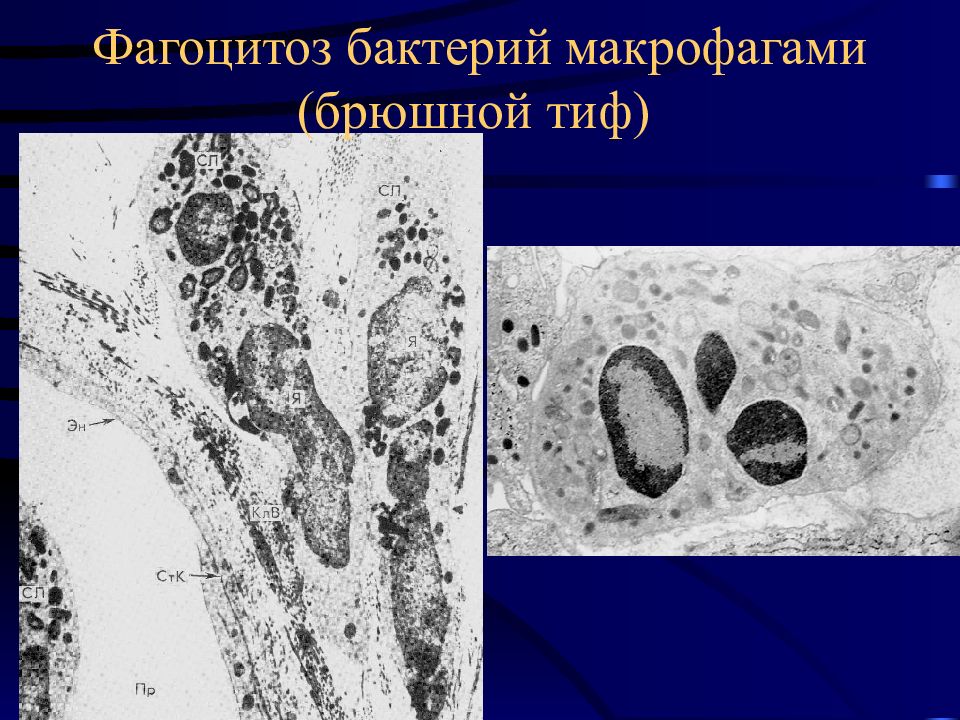 Макрофаги фагоцитоз. Патоморфология брюшного тифа. Фагоцитоз бактерий. Фагоцитоз микроорганизмов. Фагоцитоз воспаление.