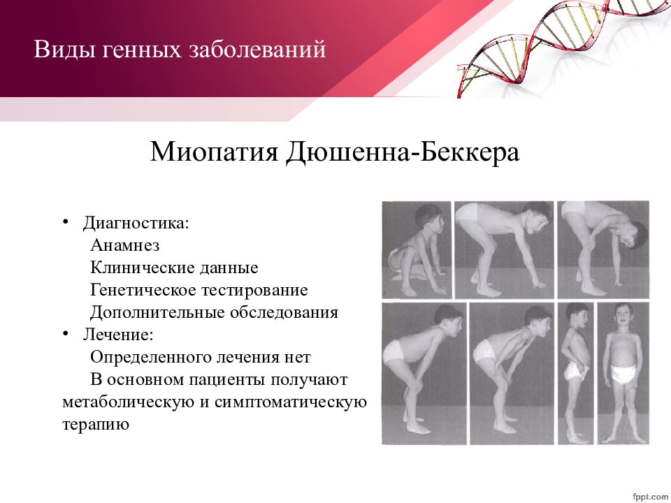 Мышечная дистрофия дюшенна презентация