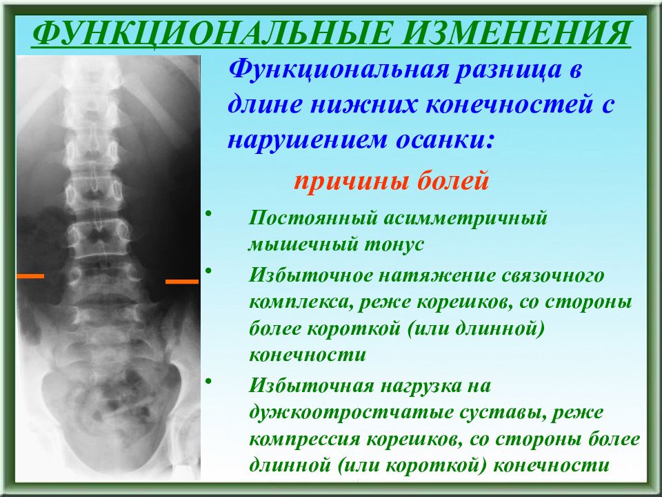 Функциональные изменения. Функциональная боль причины. Функциональная разница нижних конечностей.