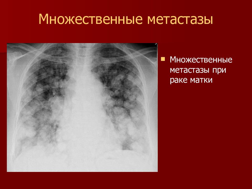 Продолжительность жизни при метастазах. Метастатические опухоли легких. Метастатическое поражение легких рентген. Метастазы легких рентгенодиагностика.