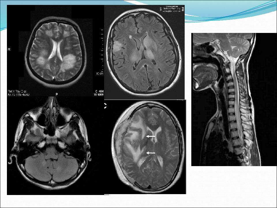 Острый рассеянный энцефаломиелит презентация