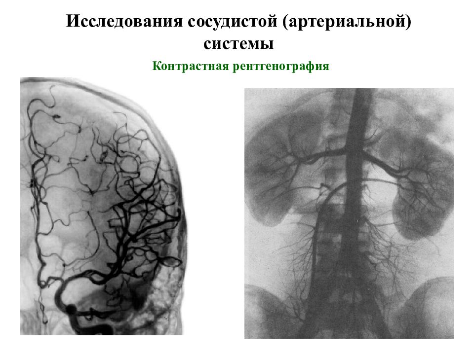 Сосудистые исследования. Рентгенография сосудистой системы. Контрастное рентгенографическое изображение бронхов называется. Графика рентген сосудов. Дислокация сосуда рентген.