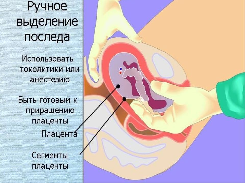 Послеродовое кровотечение картинки