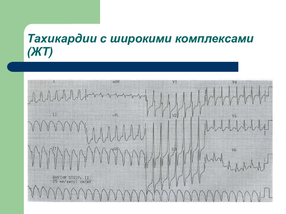 Широкий комплекс. Тахикардия с широкими комплексами на ЭКГ. Пароксизмальная тахикардия с широким комплексом QRS. Желудочковая тахикардия с широкими комплексами на ЭКГ. Наджелудочковая тахикардия с широкими комплексами ЭКГ.