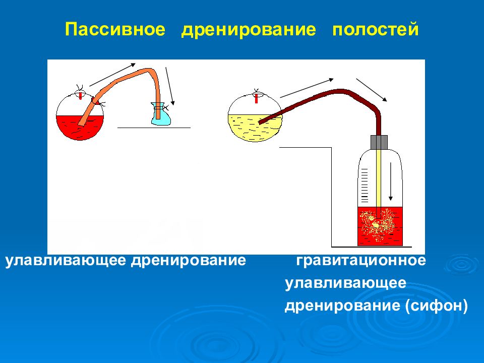 Дренирование. Пассивное и активное дренирование РАН. Проточно промывное дренирование. Физическая антисептика, пассивное дренирование. Пассивное дренировани.