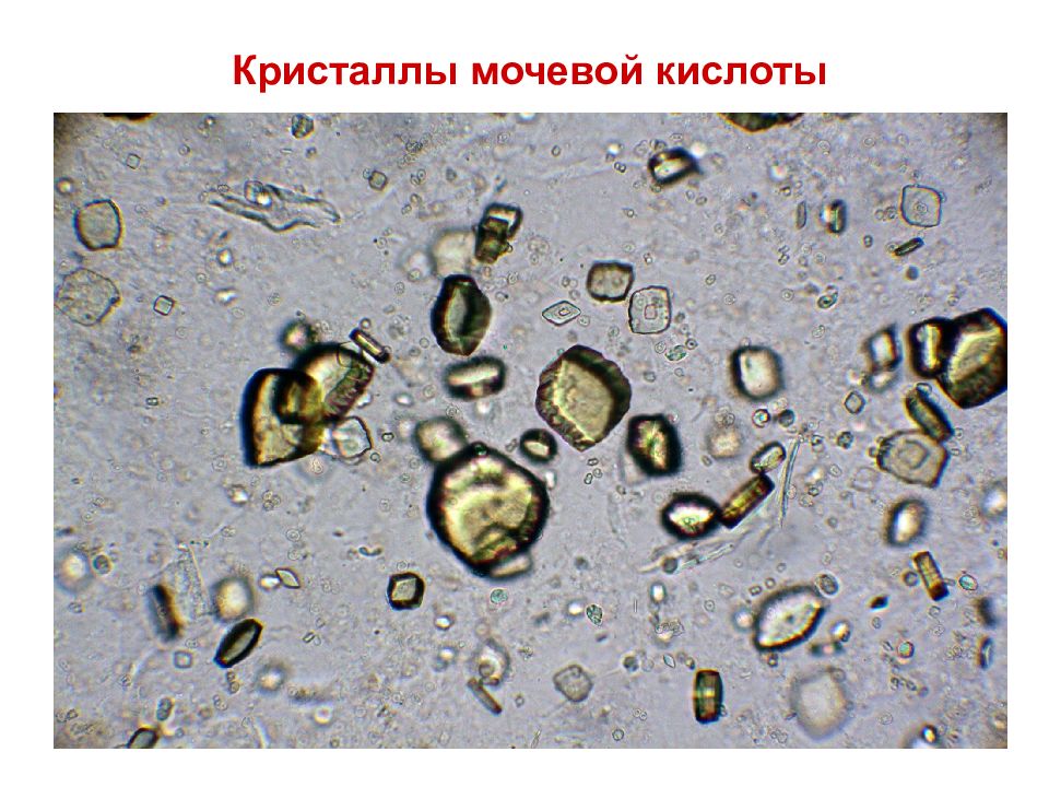 Кристаллы мочевой кислоты фото