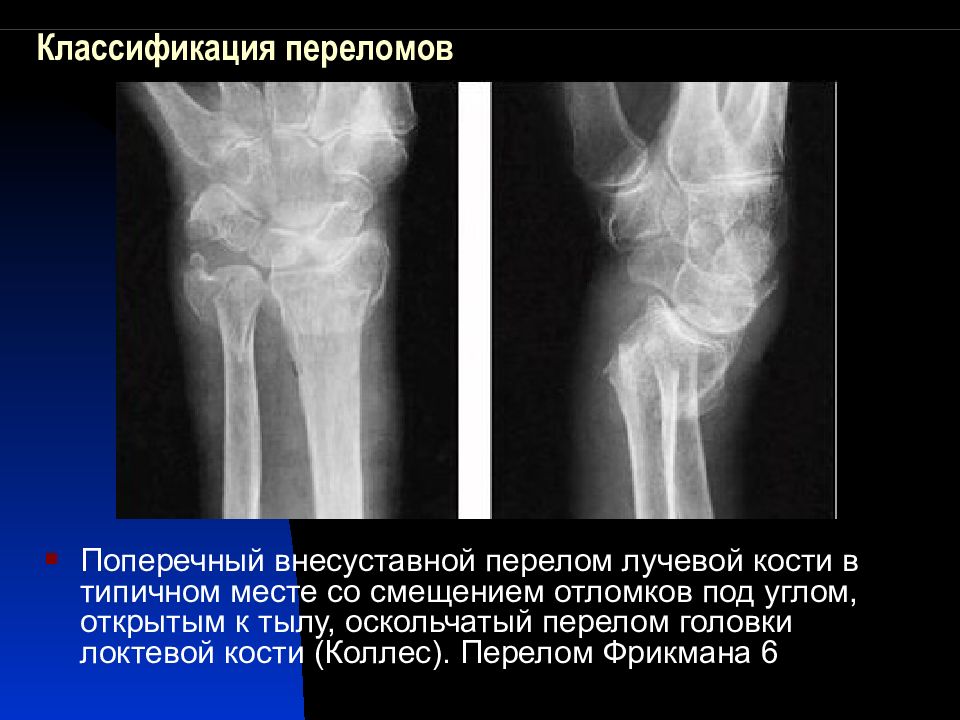 Перелом лучевой кости карта вызова смп