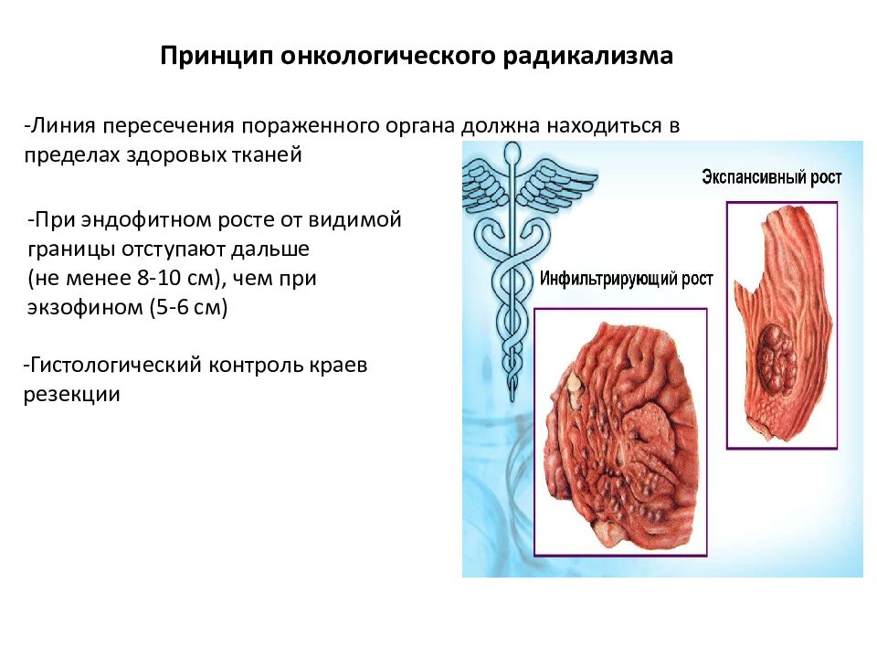 Алгогены выделяемые онкологическими опухолями. Онкология презентация. Эндофитный рост опухоли. Онкологические принципы.