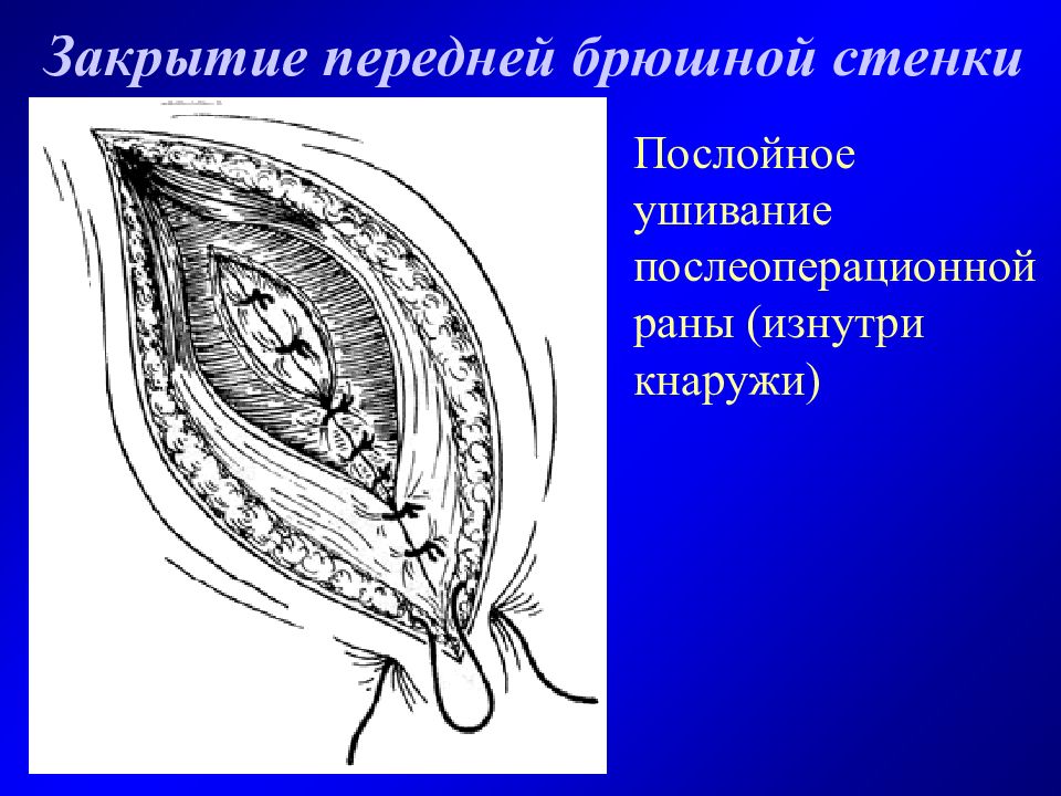 Операции брюшной. Зашивание раны передней брюшной стенки. Послойное ушивание передней брюшной стенки. Послойное ушивание раны брюшной стенки.