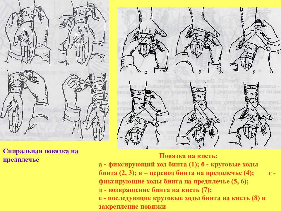 Фиксирующие ходы повязки. Фиксирующие ходы повязки. Фиксирующие ходы повязки. Фиксирующие ходы повязки. Бинтование культи бедра.