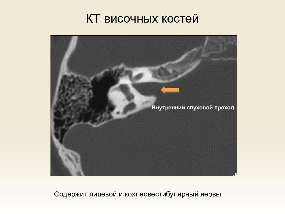 Внутренний слуховой проход. Внутренний слуховой проход на кт. Внутренний слуховой проход анатомия кт. Внутренний слуховой проход на кт височных костей. Внутренний слуховой проход височной кости.