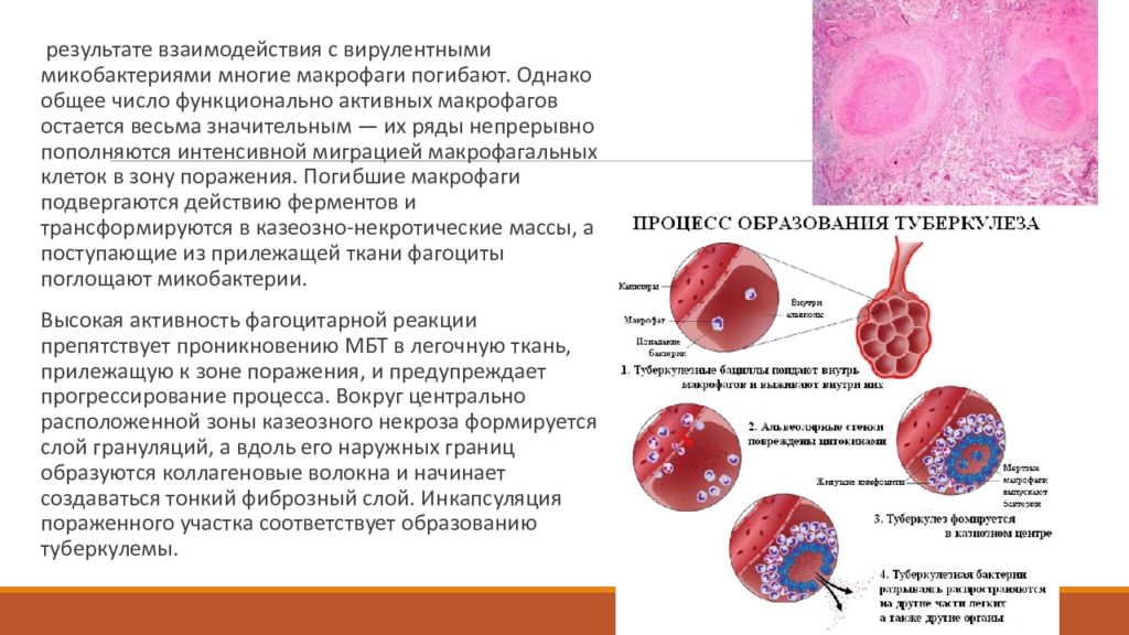 Презентация туберкулема легких