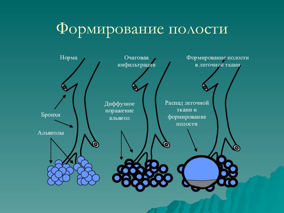 Формирование полости. Синдром полости в легочной ткани. Полость в легочной ткани. Воздушная полость в легком сообщающейся с бронхом.