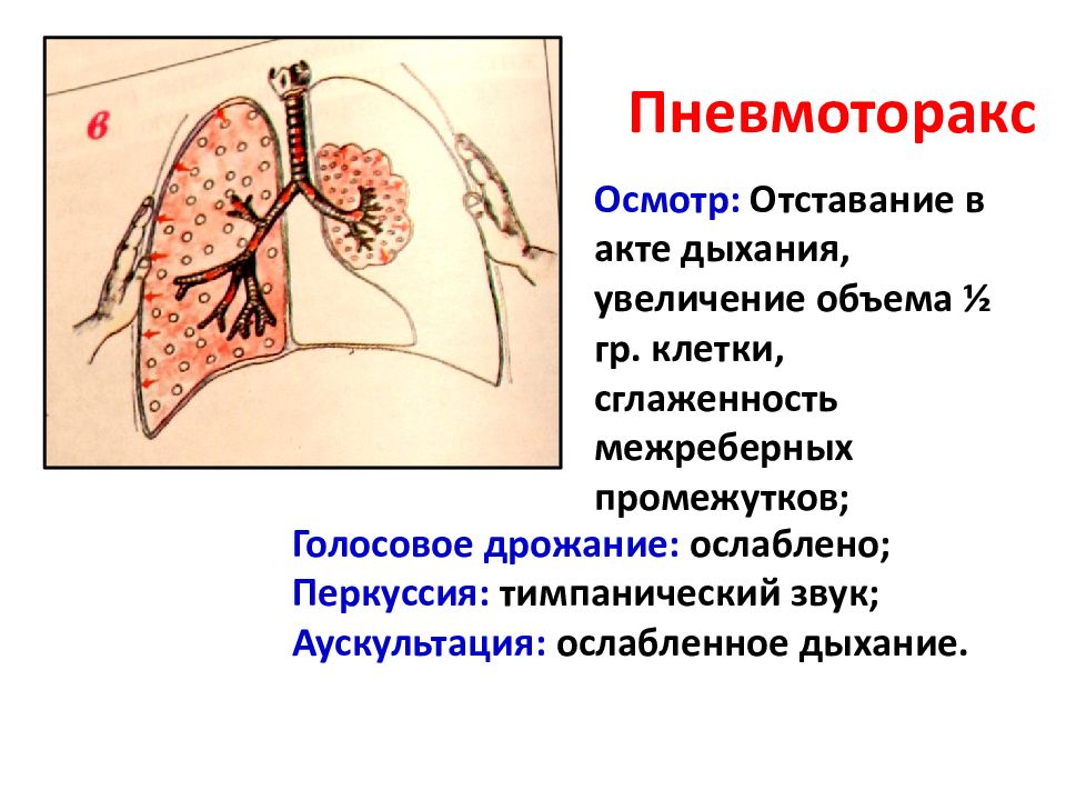 Соединенные легкие