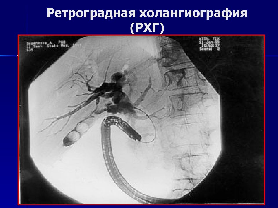 Мрт холангиография. Ретрогроградная холангилграфия. Ретроградная холангиография. Ретроградная панкреатохолангиография. Холангиография ретроградная панкреатография.