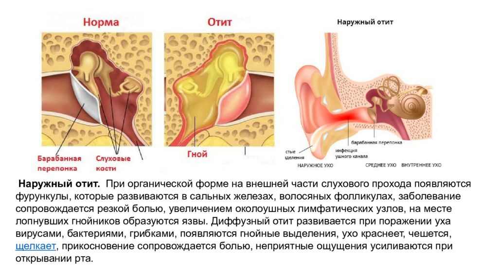 При открытии рта болит ухо. Заболевания среднего уха. Заболевания среднего уха фото.