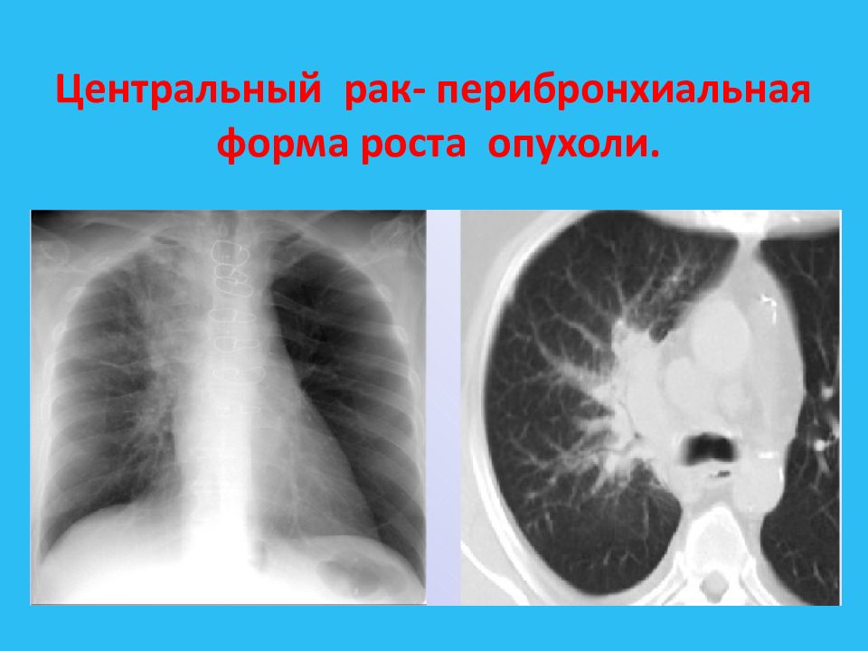 Центральный рак кт. Перибронхиальная опухоль. Перибронхиально Узловая форма. Перибронхиальный рост. Эндобронхиальный рост опухоли.