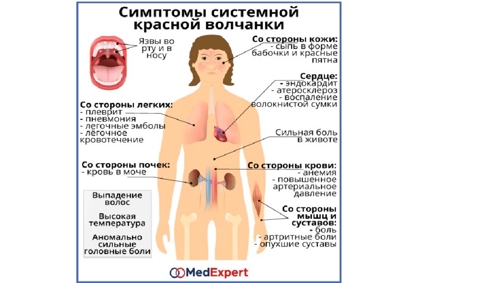 Системная красная. Красная волчанка системная боррелиоз. Сыпь при системной красной волчанке. Системная красная волчанка диагностика и симптомы. Красная волчанка симптомы анализ.