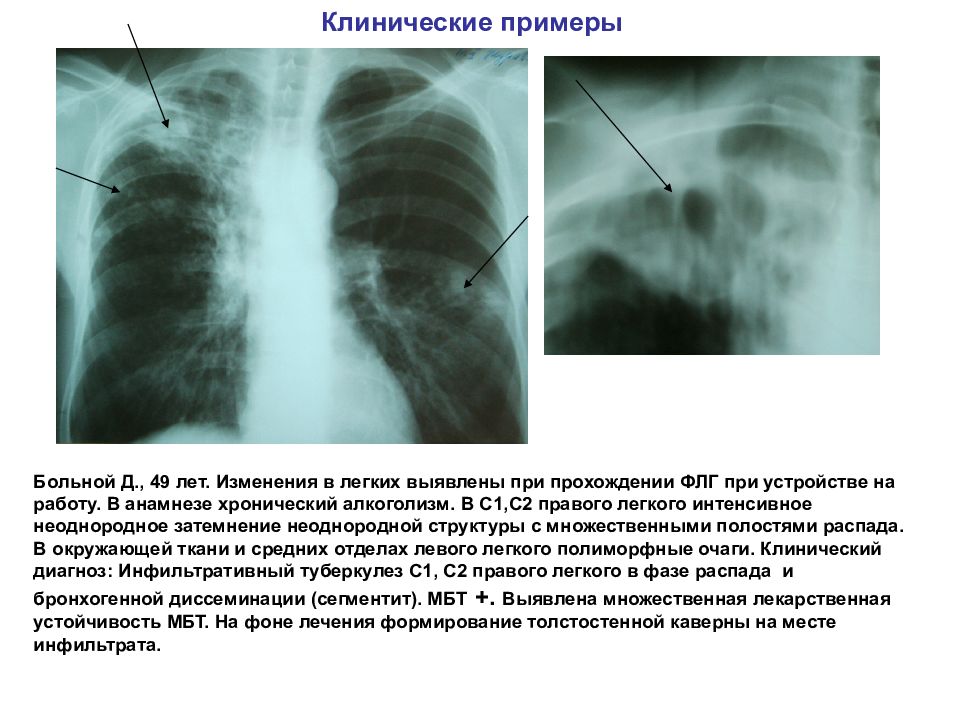 Очаговый и инфильтративный туберкулез презентация