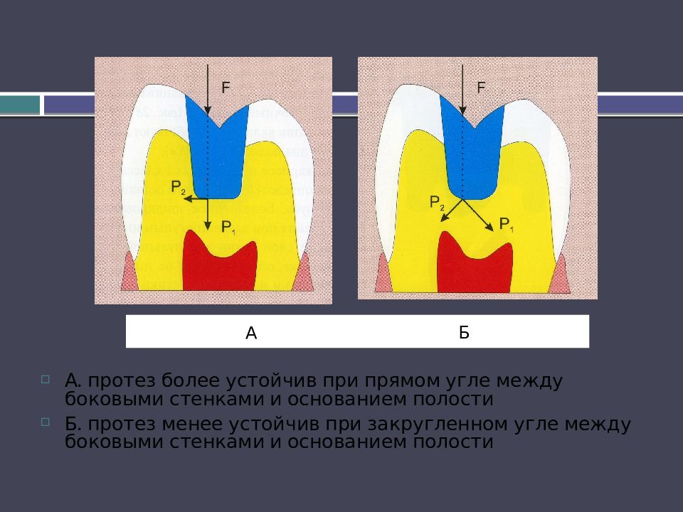 Ошибки и осложнения при изготовлении вкладок, виниров, штифтовых конструкций