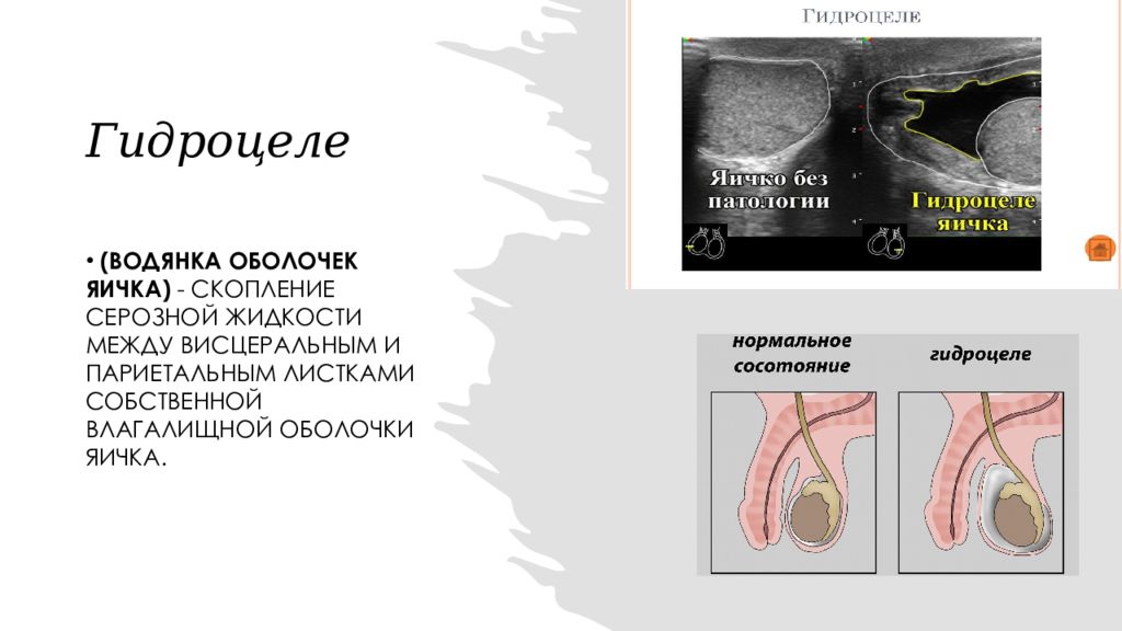 Гидроцеле яичка. Заболевания органов мошонки. Водянка оболочек яичка. Патология в органах мошонки. Гидроцеле классификация.