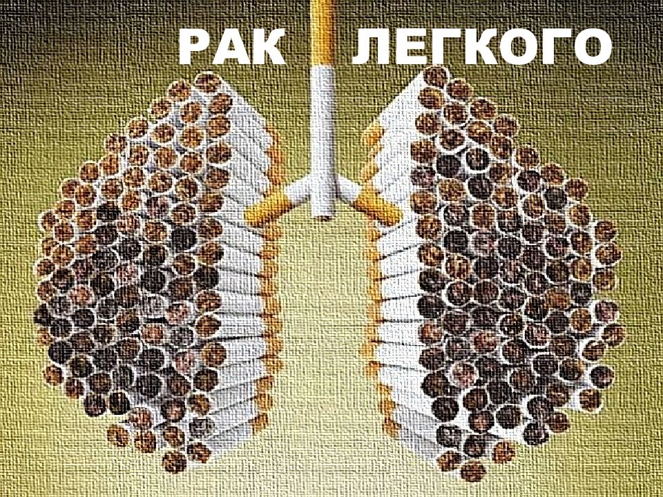 РАК ЛЕГКОГО