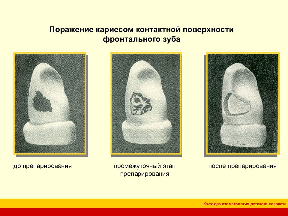 Классификация кариозных полостей по блэку презентация