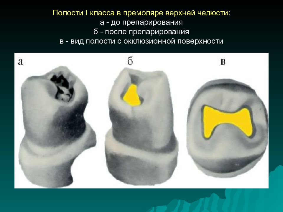 Классы по блэку в стоматологии в картинках