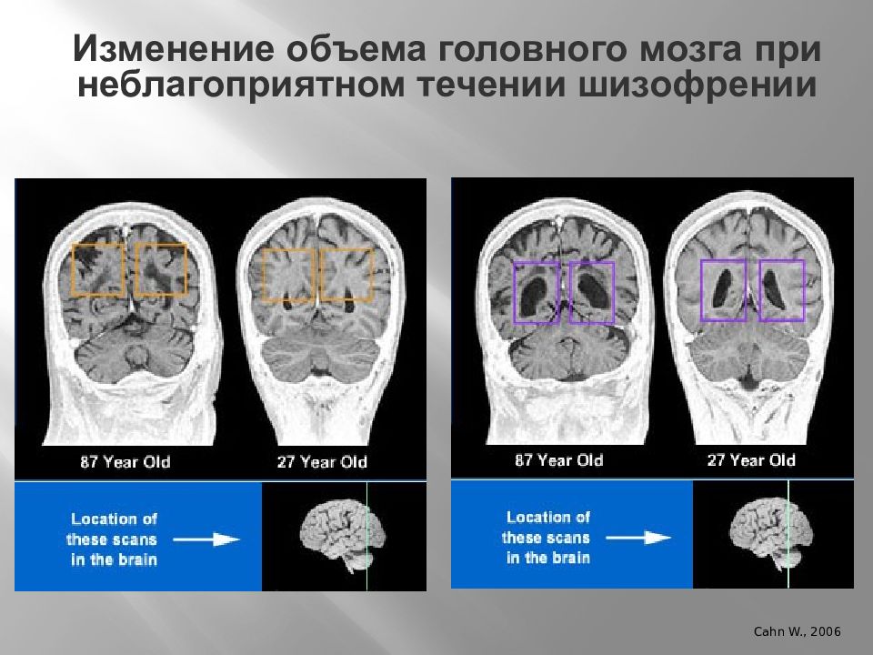 Диагностика шизофрении по картинкам