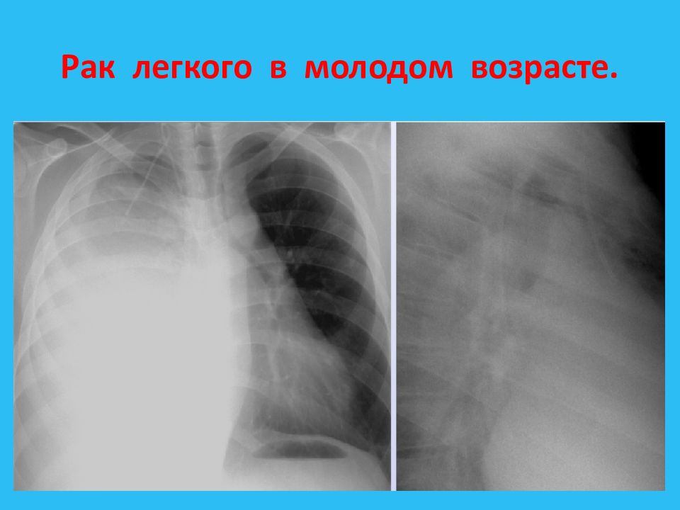 Центральный рак легкого презентация