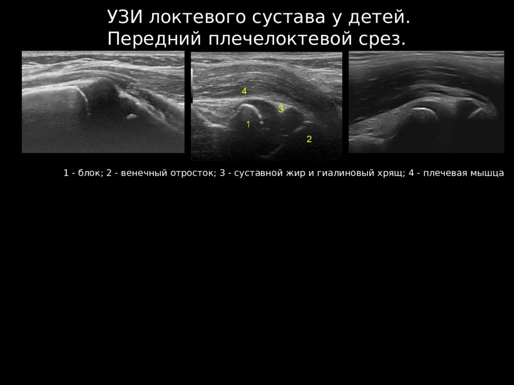 Протокол узи локтевого сустава образец