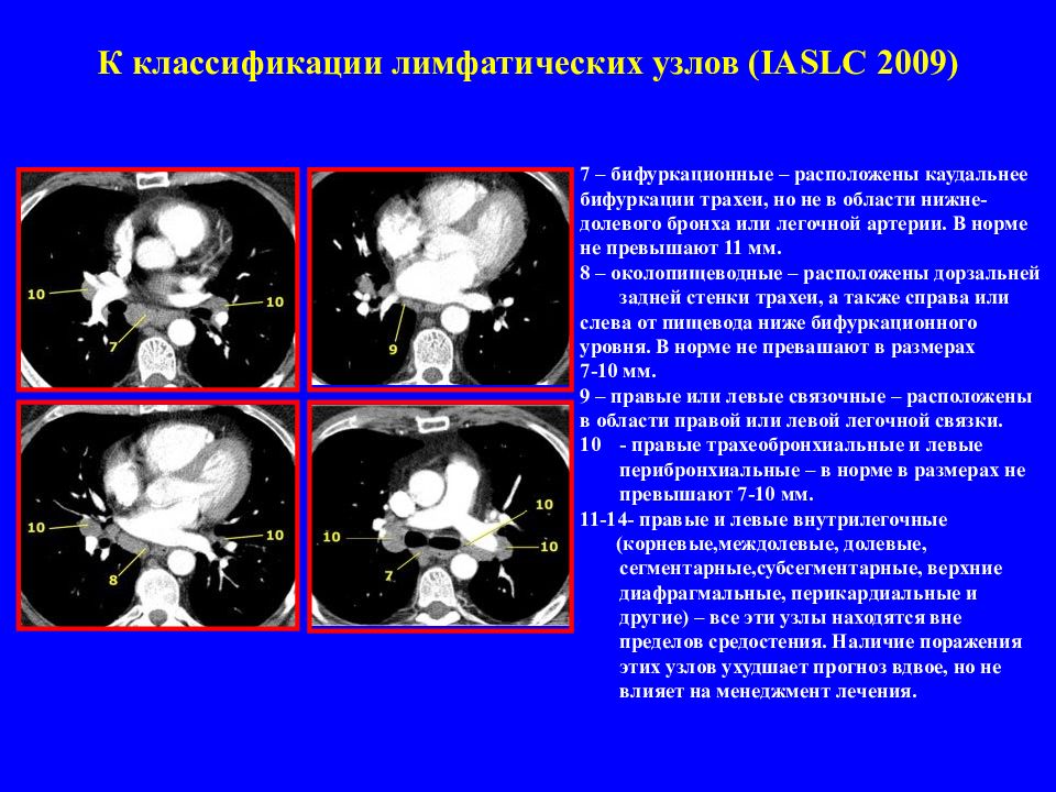 Лимфатические узлы средостения. Кт анатомия лимфатических узлов средостения. Бифуркационные лимфоузлы на кт. Бифуркационные лимфатические узлы на кт. Парааортальные лимфатические узлы кт.