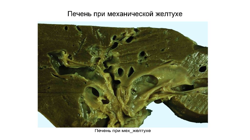 Зеленая печень. Механическая желтуха печени макропрепарат. Печень при механической желтухе макропрепарат. Подпеченочная желтуха макропрепарат описание. Печень желтуха макропрепарат.