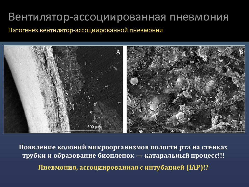 вентилятор ассоциированная пневмония