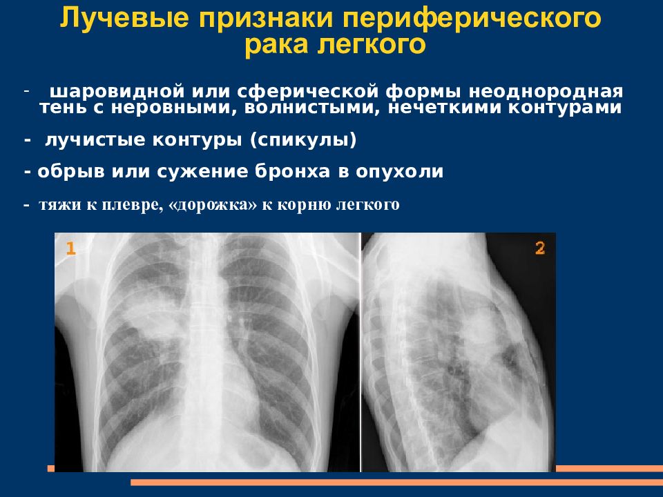 Признаки центрального рака легкого. Периферический очаг легкого. Периферический РК легкого ренгтнг. Периферические опухоли легких. Центральные опухоли легких.