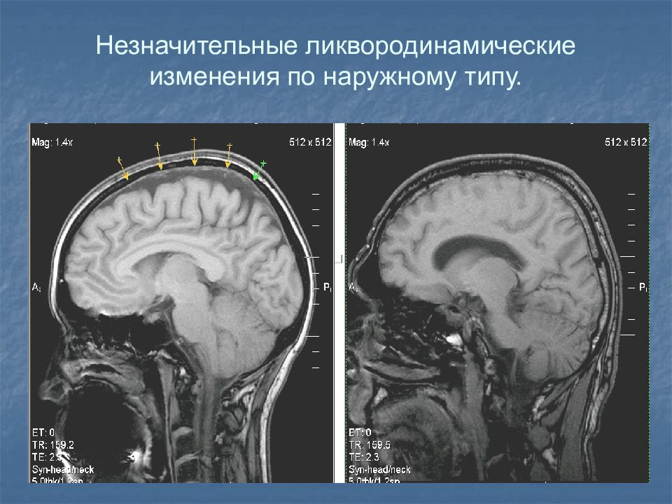 Гидроцефалия головного мозга симптомы лечение