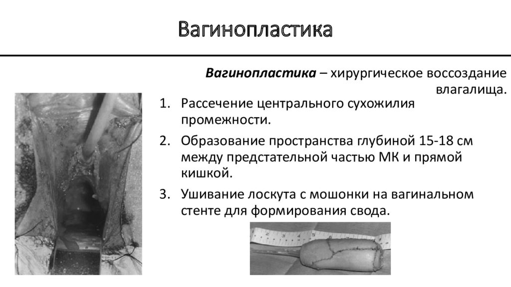 Вагинопластика до и после операции