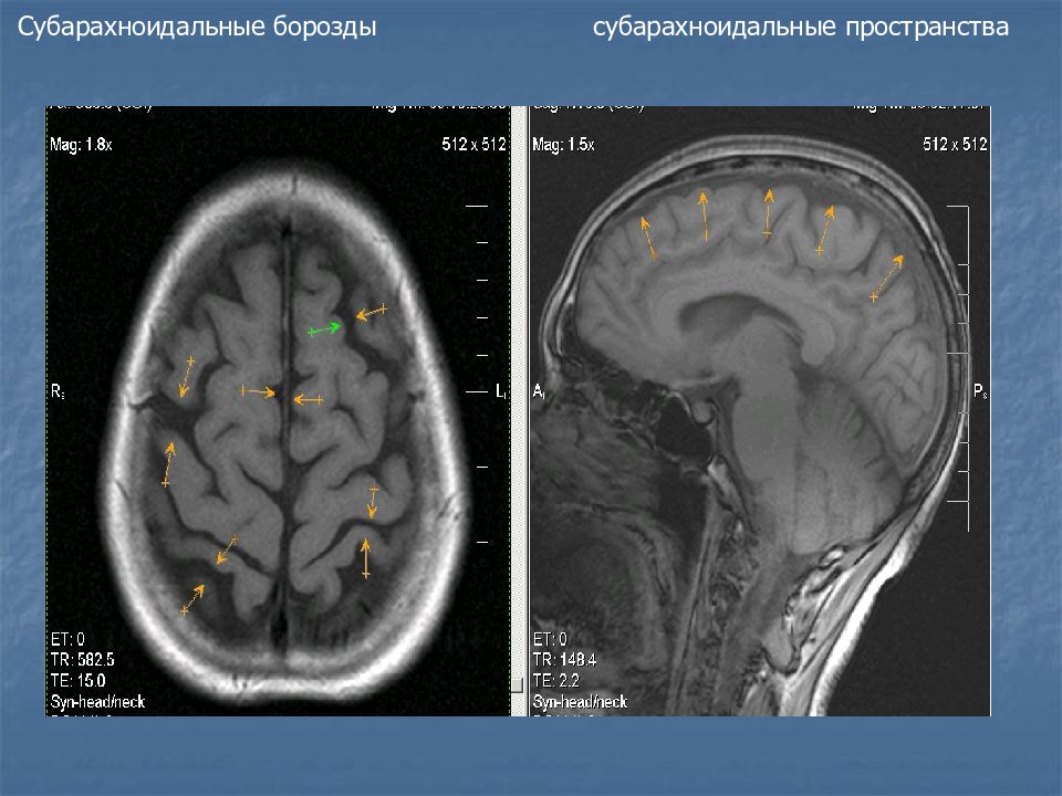 Мр признаки расширения субарахноидального пространства. Субарахноидальное пространство гидроцефалия. Наружная гидроцефалия головного мозга мрт. Обструктивная гидроцефалия мрт. Гидроцефалия головного мозга на кт.