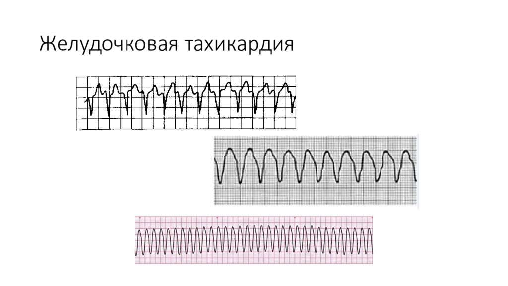 Мономорфная желудочковая тахикардия. Фасцикулярная желудочковая тахикардия на ЭКГ. Терапия желудочковой тахикардии. Желудочковая тахикардия лечение.