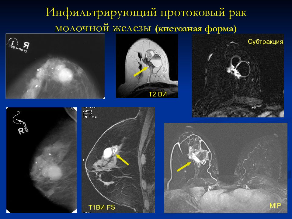 Рак молочных желез 2 стадии. Инфильтрирующая протоковая карцинома. Инфильтративно-отечной формы рака,. Опухоль протоковая молочной железы. Инфильтративная форма молочной железы.