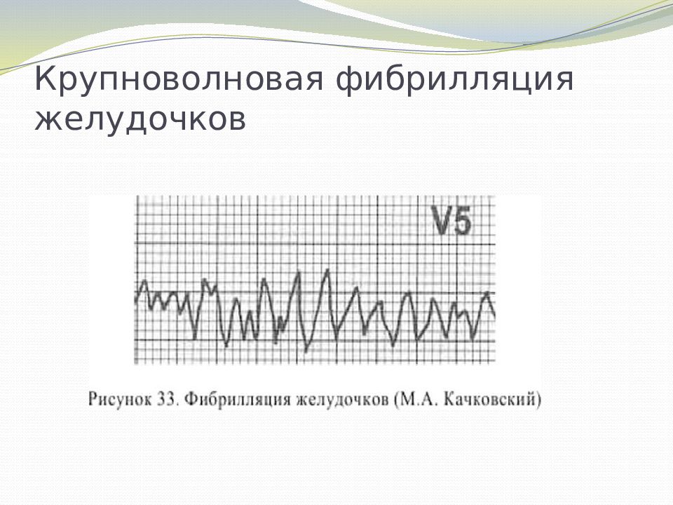 крупноволновая фибрилляция желудочков. крупноволновая фибрилляция желудочков. экг-стадий фибрилляции желудочков. крупноволновая фибрилляция желудочков. вентрикулярная фибрилляция желудочков.