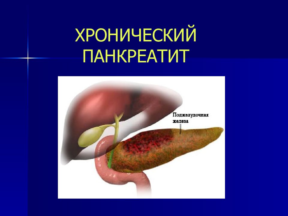 Панкреатит в картинках