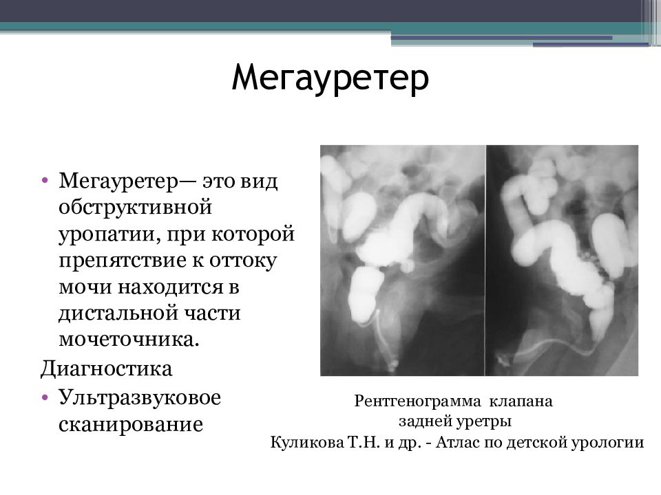 Мегауретер у детей презентация